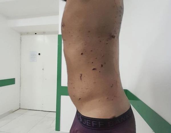 His left side received puncture wounds