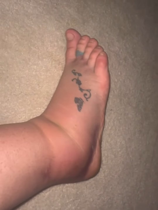 Britney Spears shows fans her swollen foot in an Instagram post