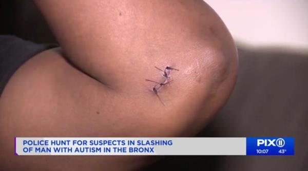 Footage of the victim's stitches